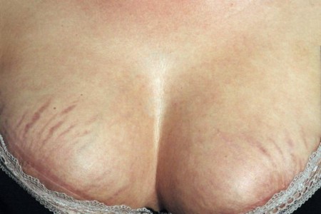 Растяжки на груди. Лечение и профилактика